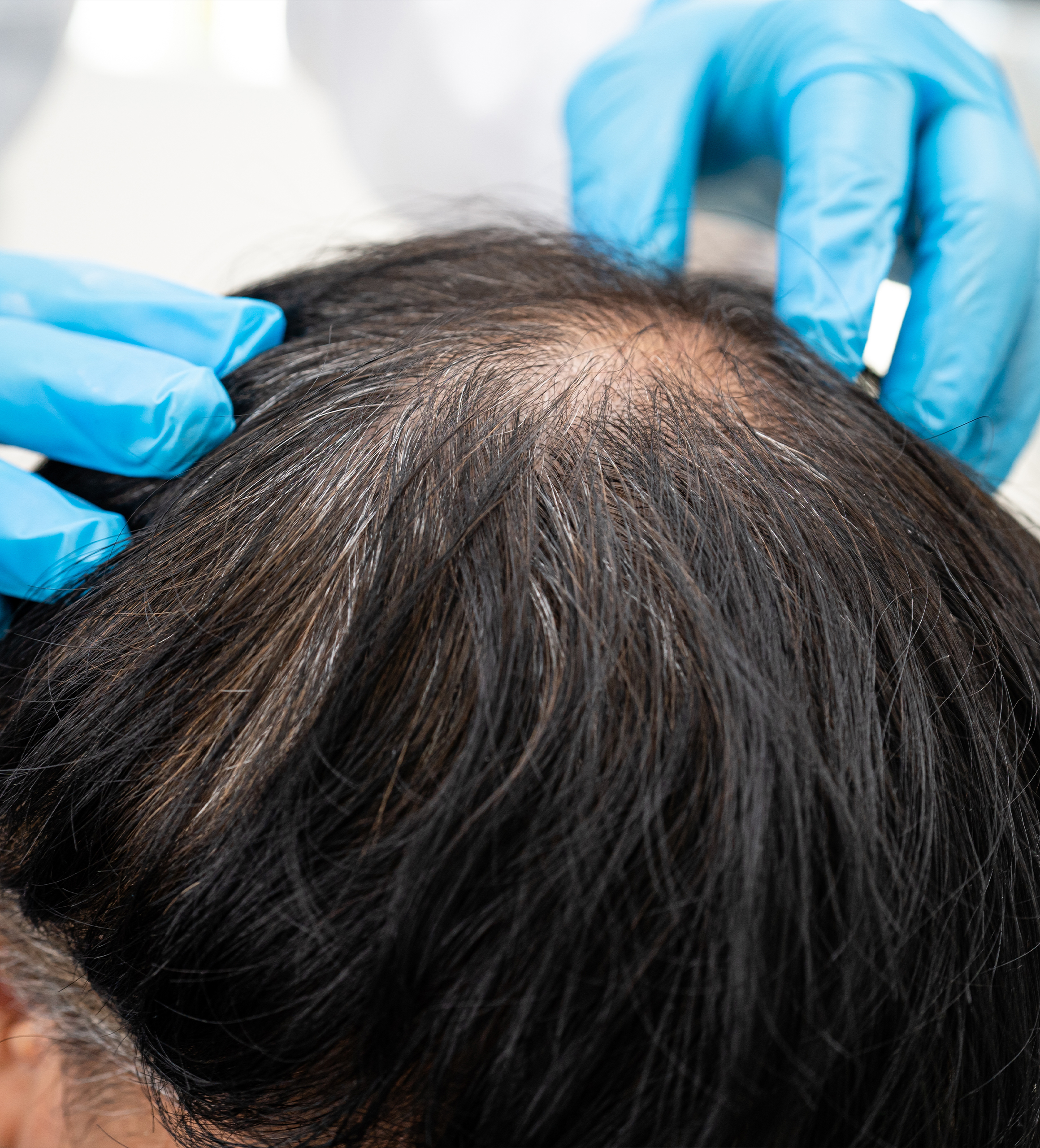 Alopecia