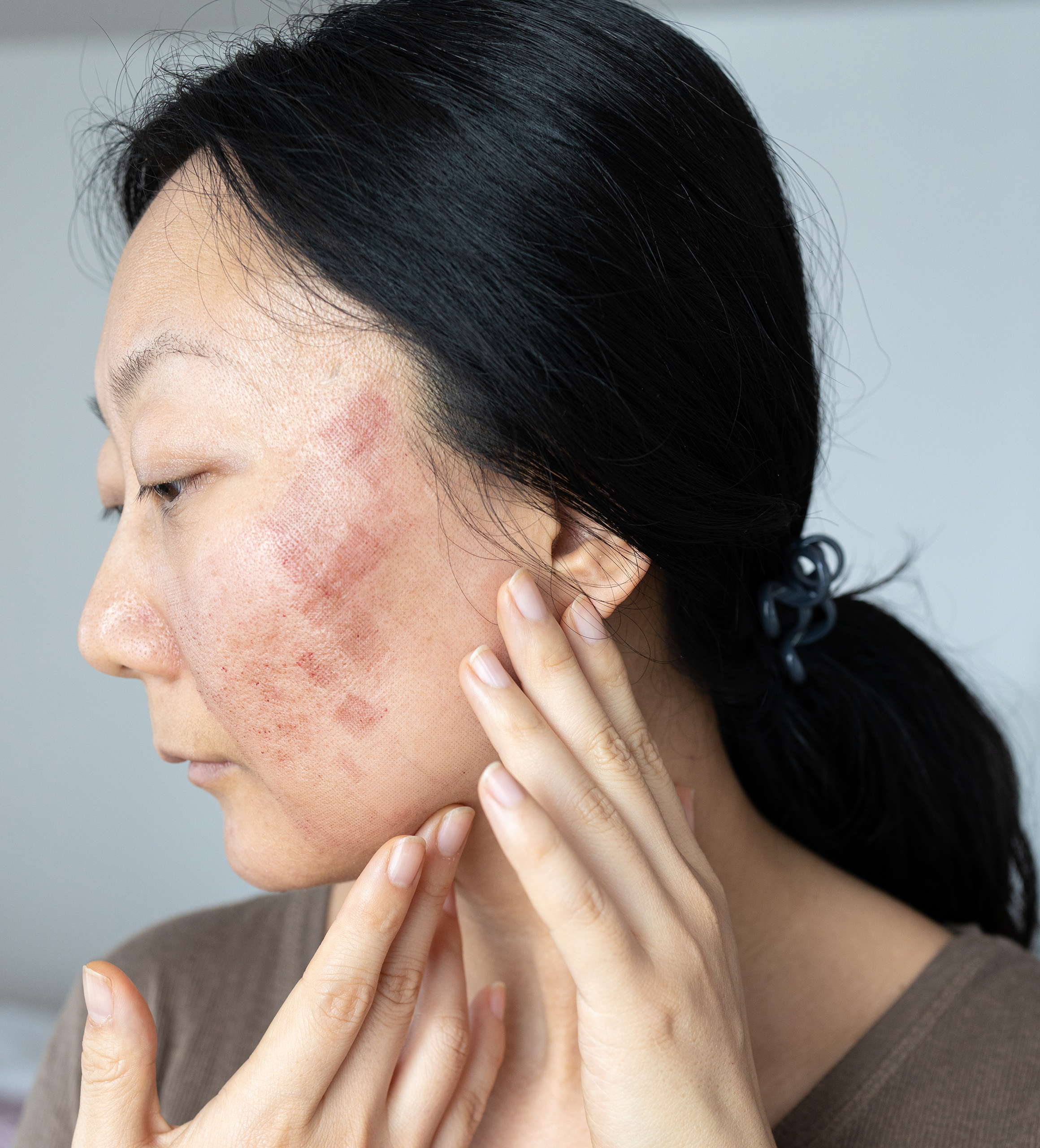 Lupus